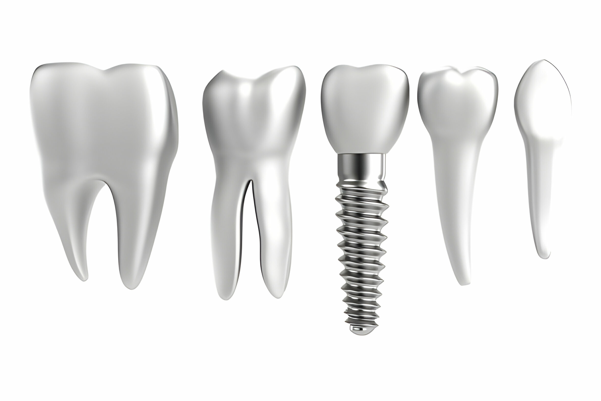 What Are The Benefits Of Dental Implants In Dallas?_1