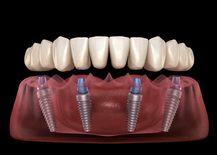 All-On-4 Dental Implant