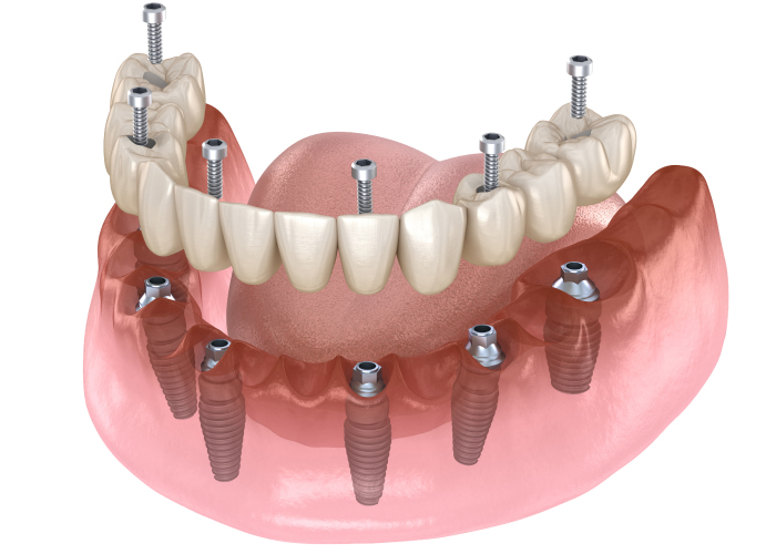Fixed vs. Removable Implant Options