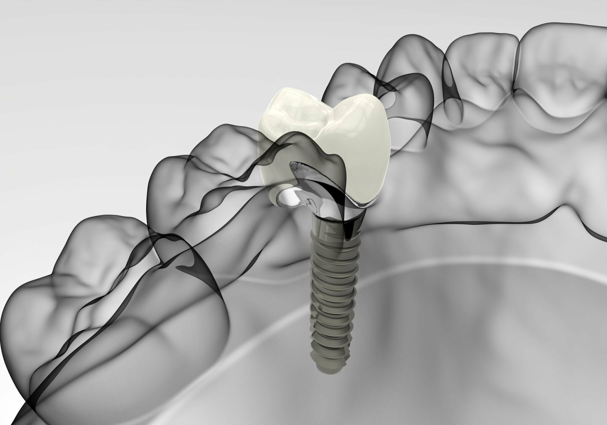 What Are The Benefits Of Dental Implants In Dallas?_FI