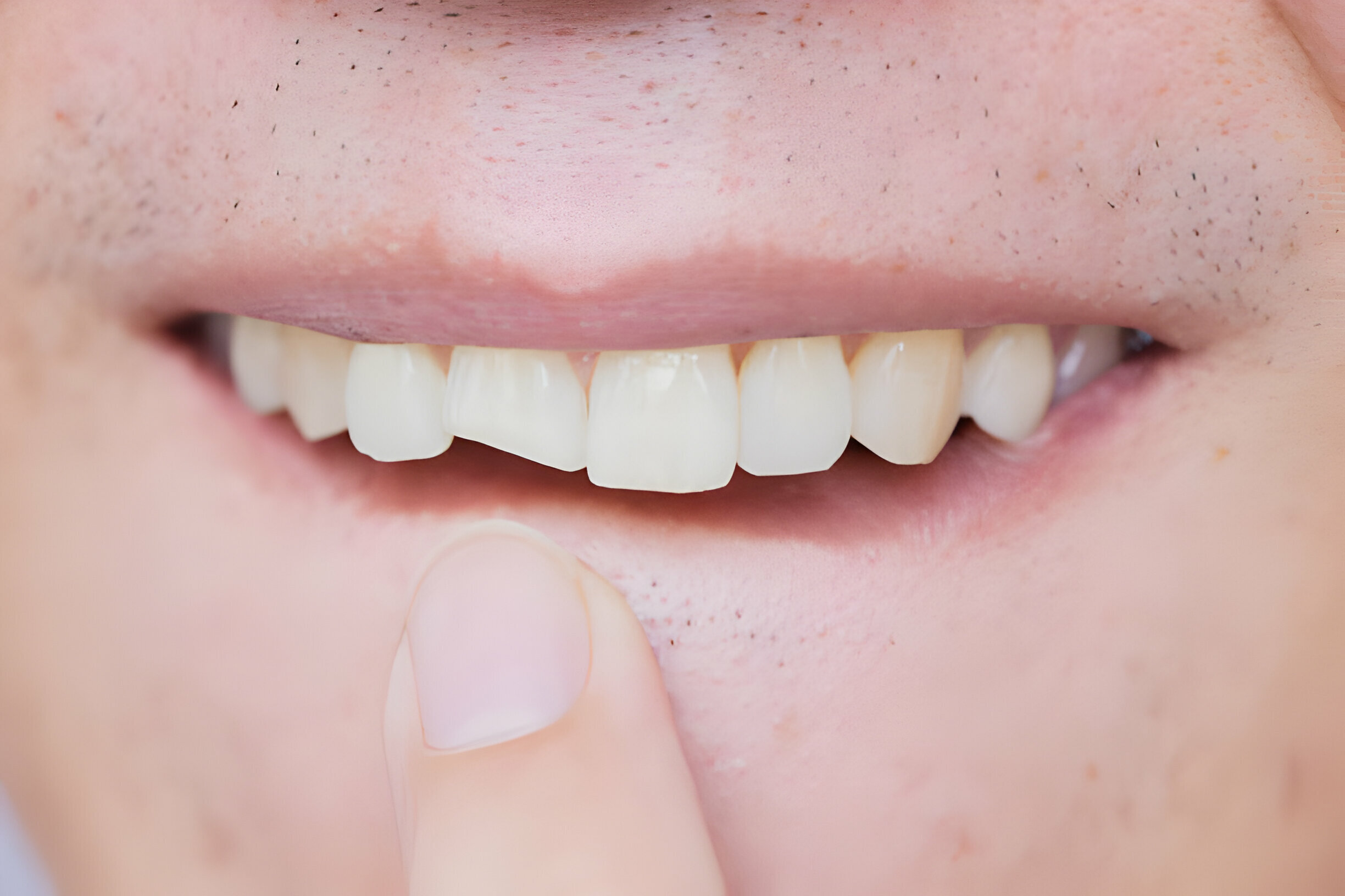 Explore Various Options and Costs to Fix A Broken Tooth_FI