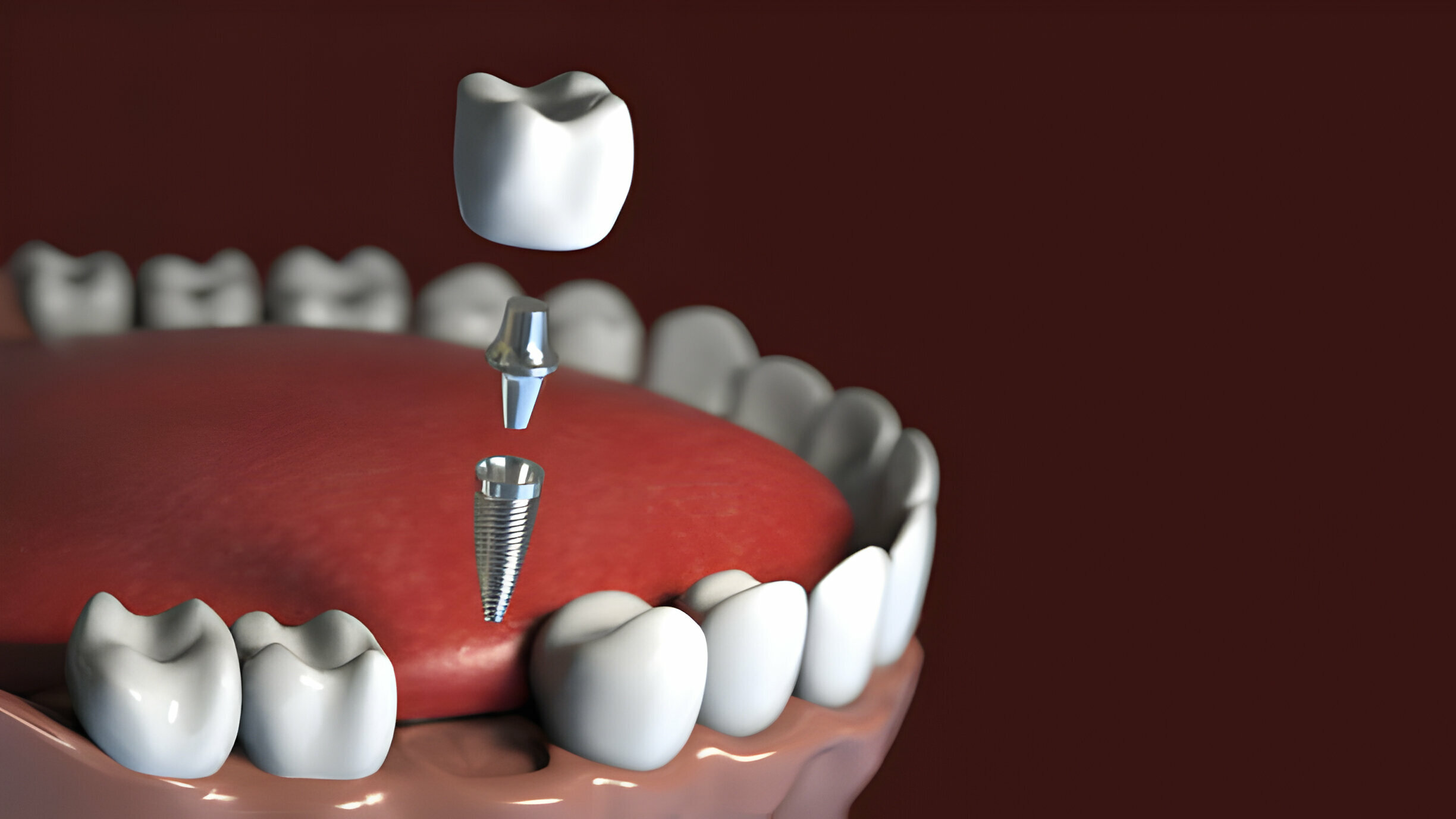 Finding the Best Dental Implant Specialist: Tips and Insights_FI