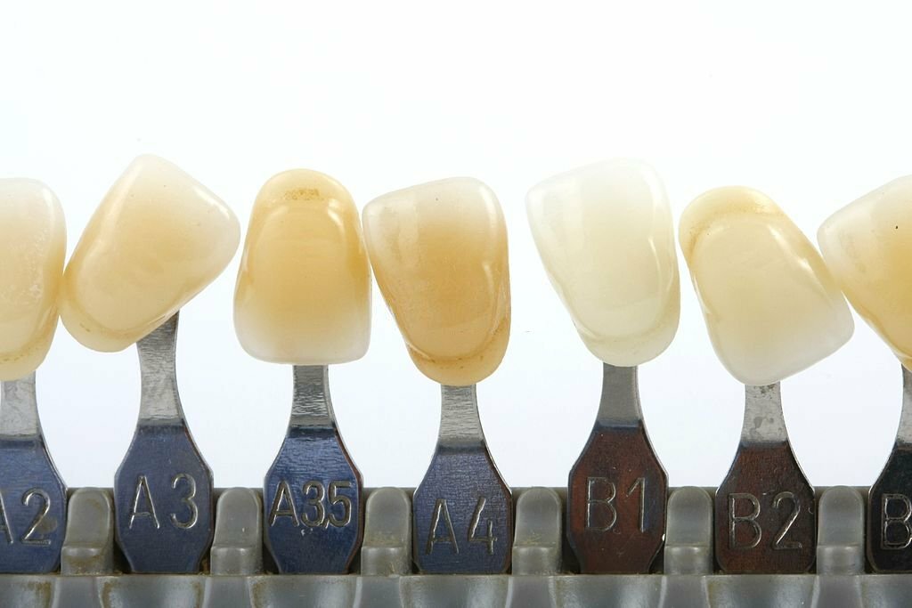 The Ultimate Guide to Best Veneers Dallas_FI