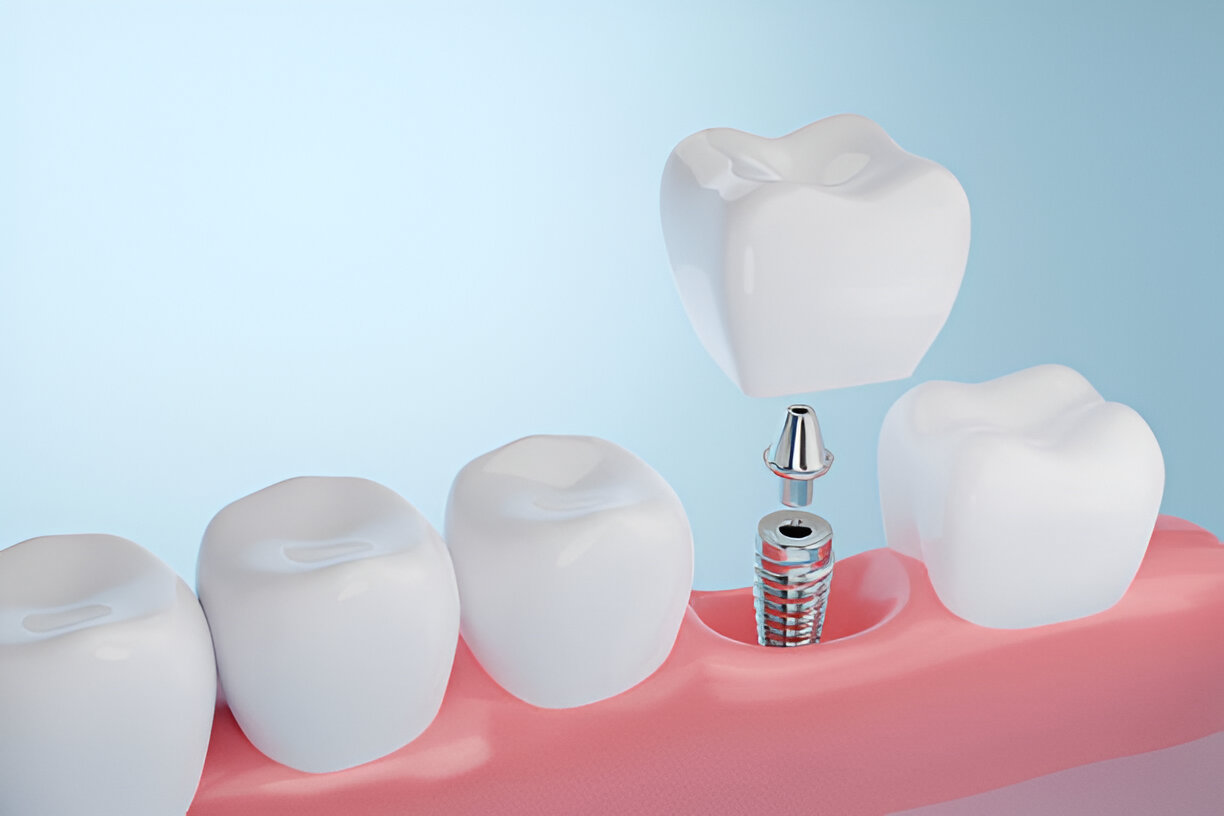From Consultation to Care: Dental Implants Journey at Seven Hills Dentistry in Dallas, GA_FI