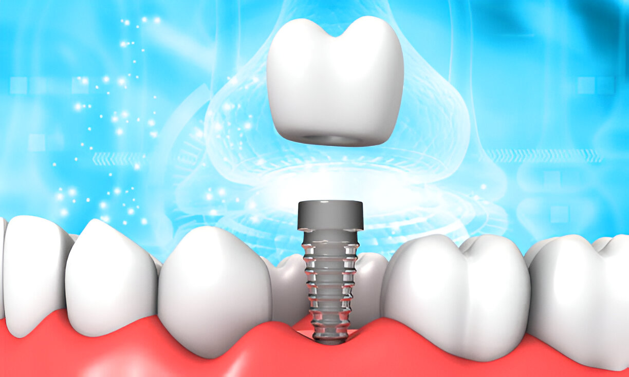 How to Choose the Best Type of Dental Implant for Your Needs_FI