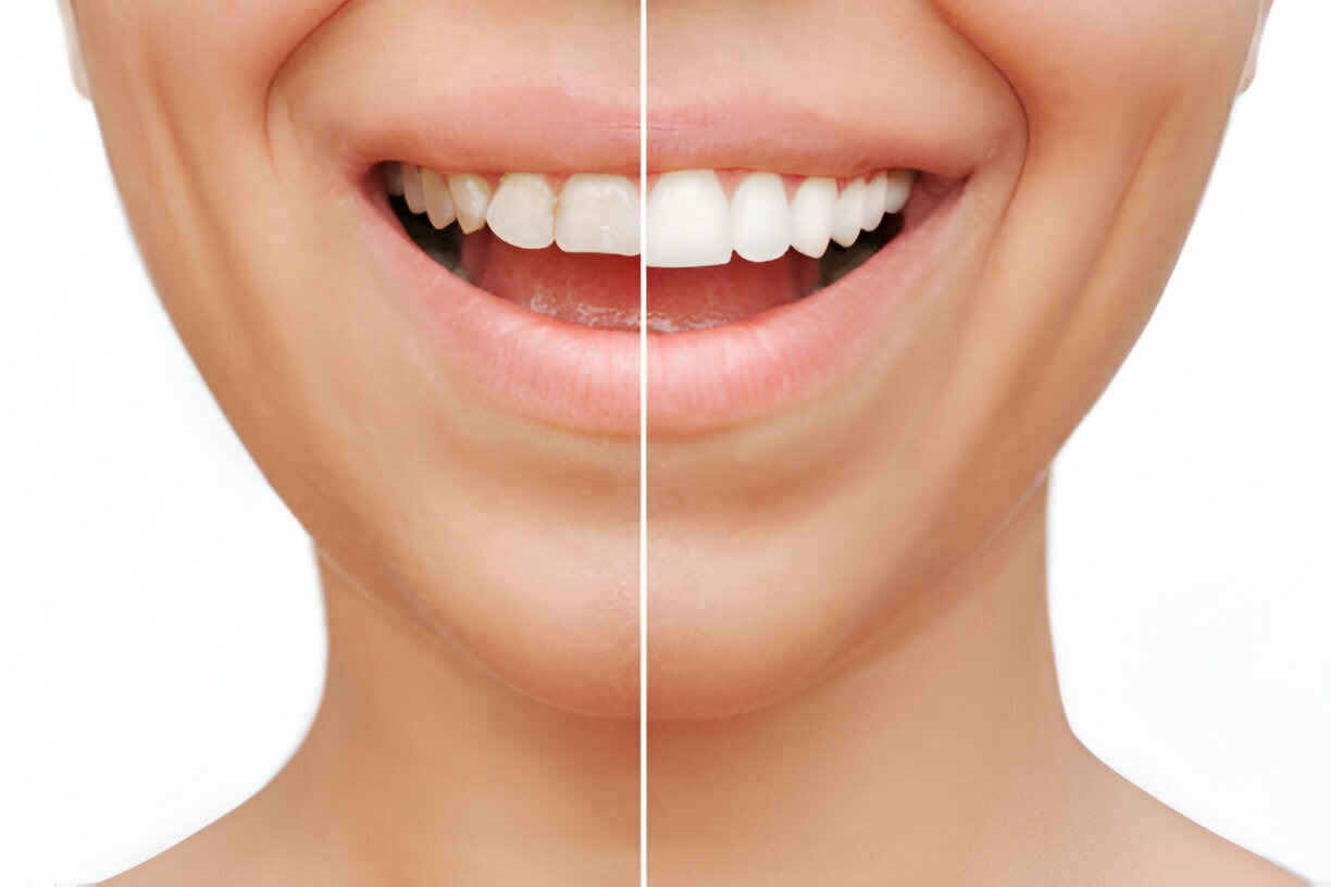Porcelain Dental Veneers for a Perfect Smile: What to Expect?_FI