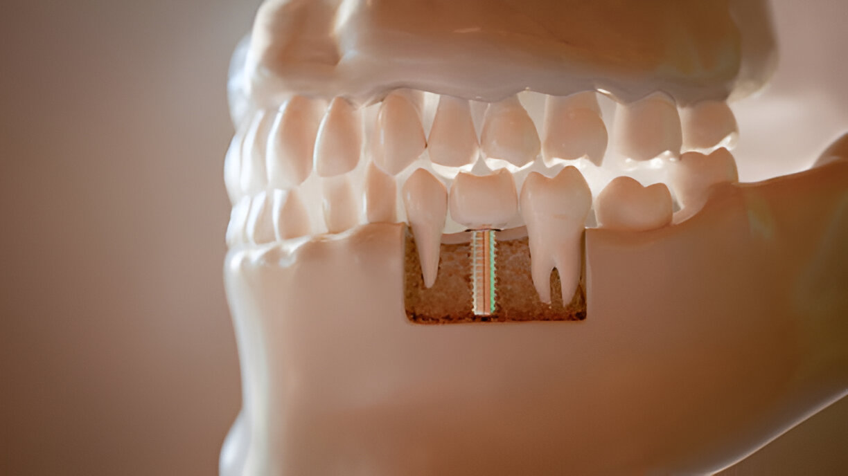 How to Choose the Best Type of Dental Implant for Your Needs_3