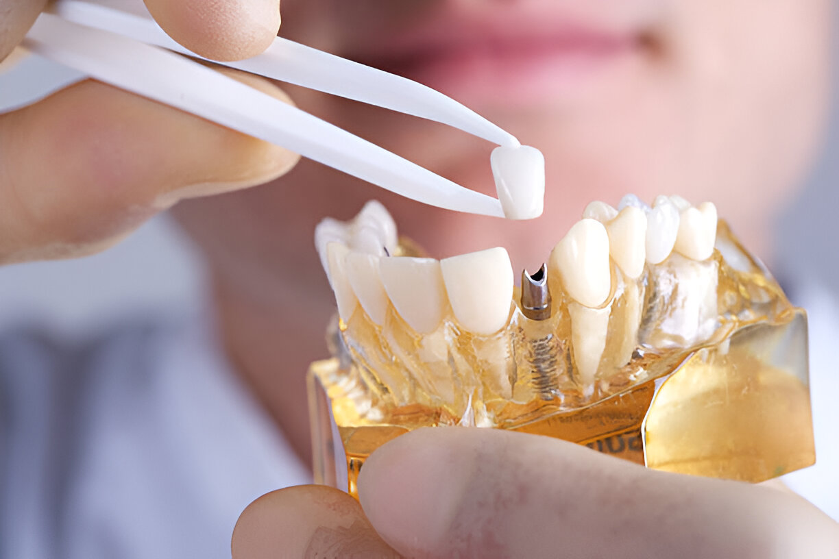 Porcelain Dental Veneers for a Perfect Smile: What to Expect?_1