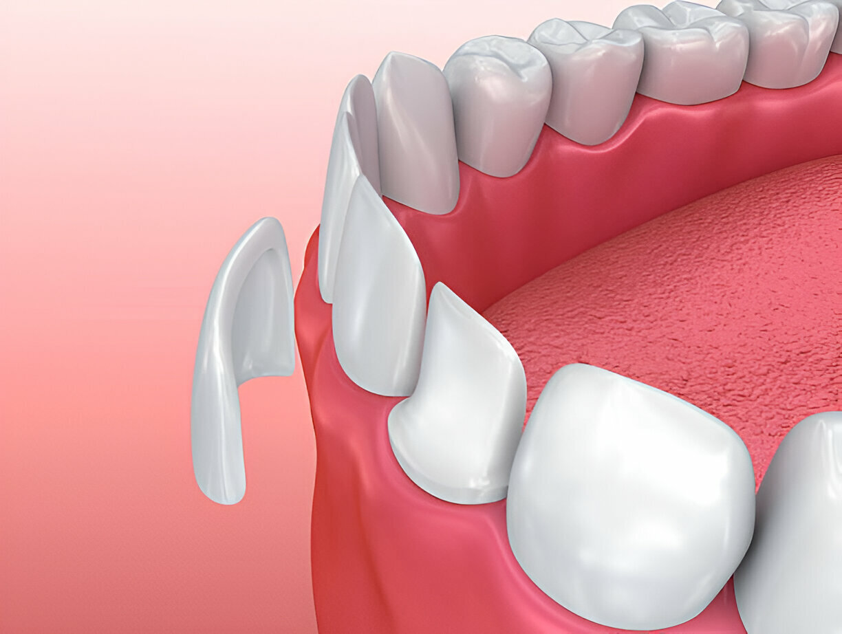 Porcelain Dental Veneers for a Perfect Smile: What to Expect?_2