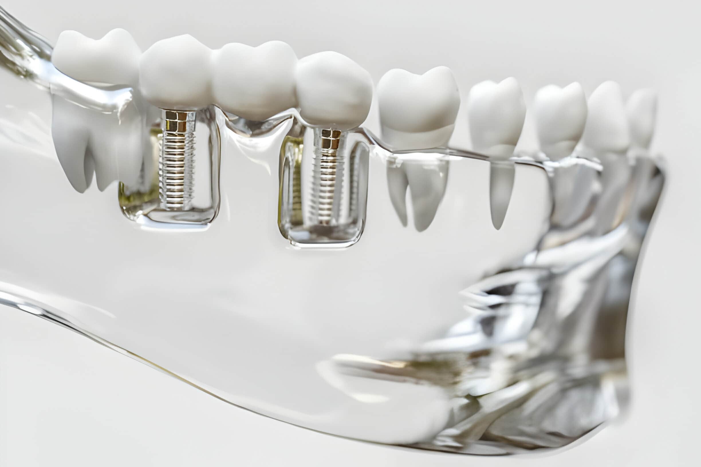 Finding the Best Dental Implant Specialist: Tips and Insights_3