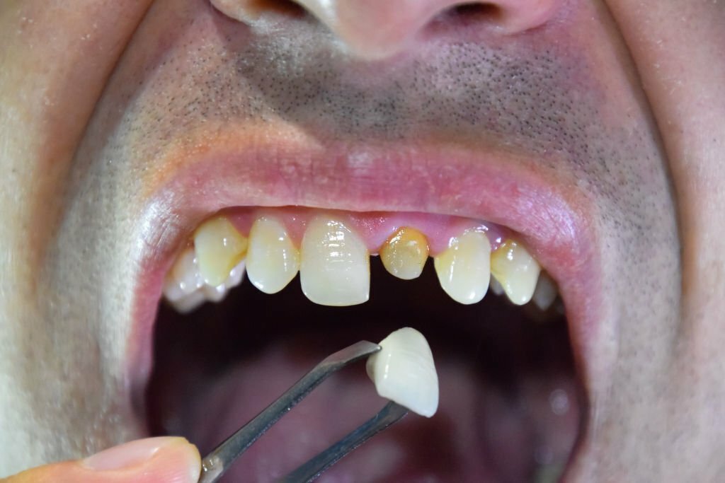 The Ultimate Guide to Best Veneers Dallas_2