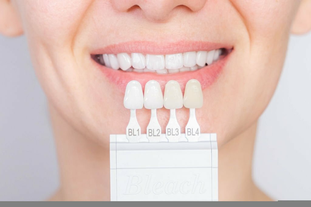 The Ultimate Guide to Best Veneers Dallas_3
