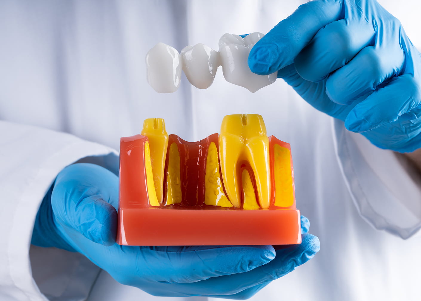 dental bridge for missing tooth replacement