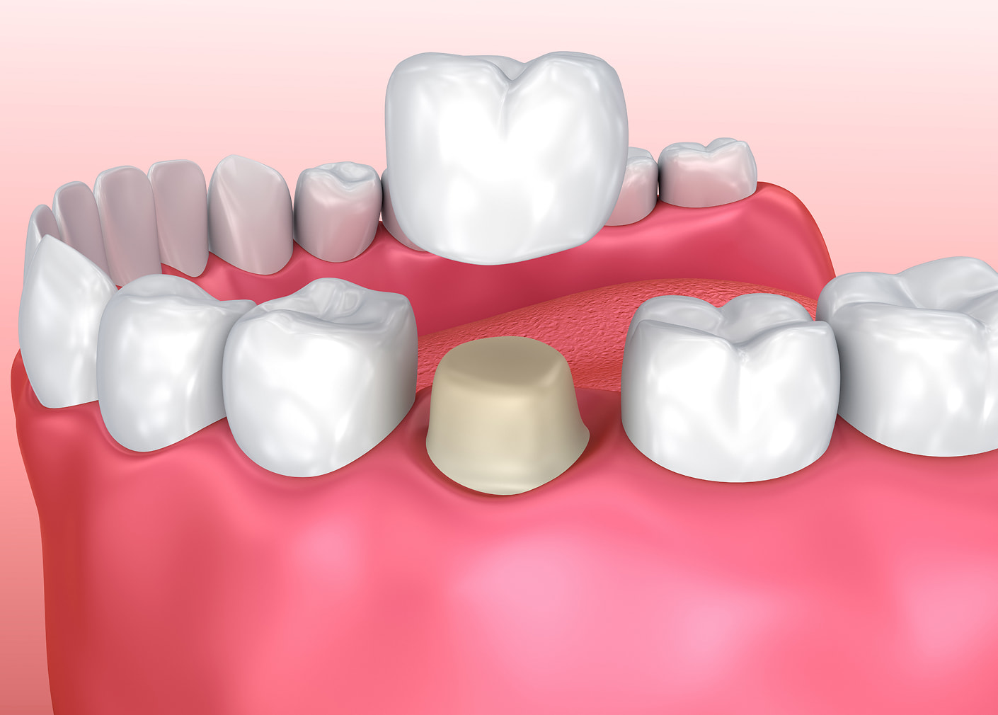 Dental crown to protect and restore damaged tooth
