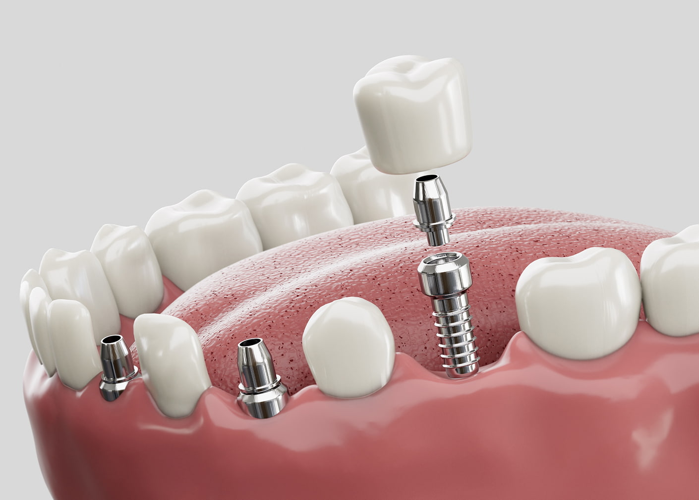 Welcoming dental implant care in Dallas, GA