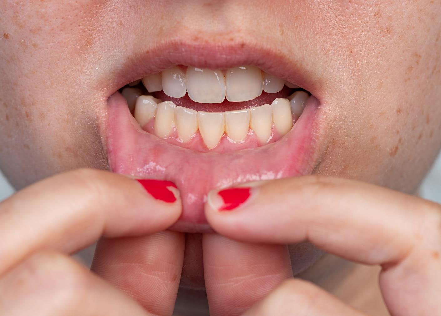 Frenectomy for tongue-tie, speech, or gum issues