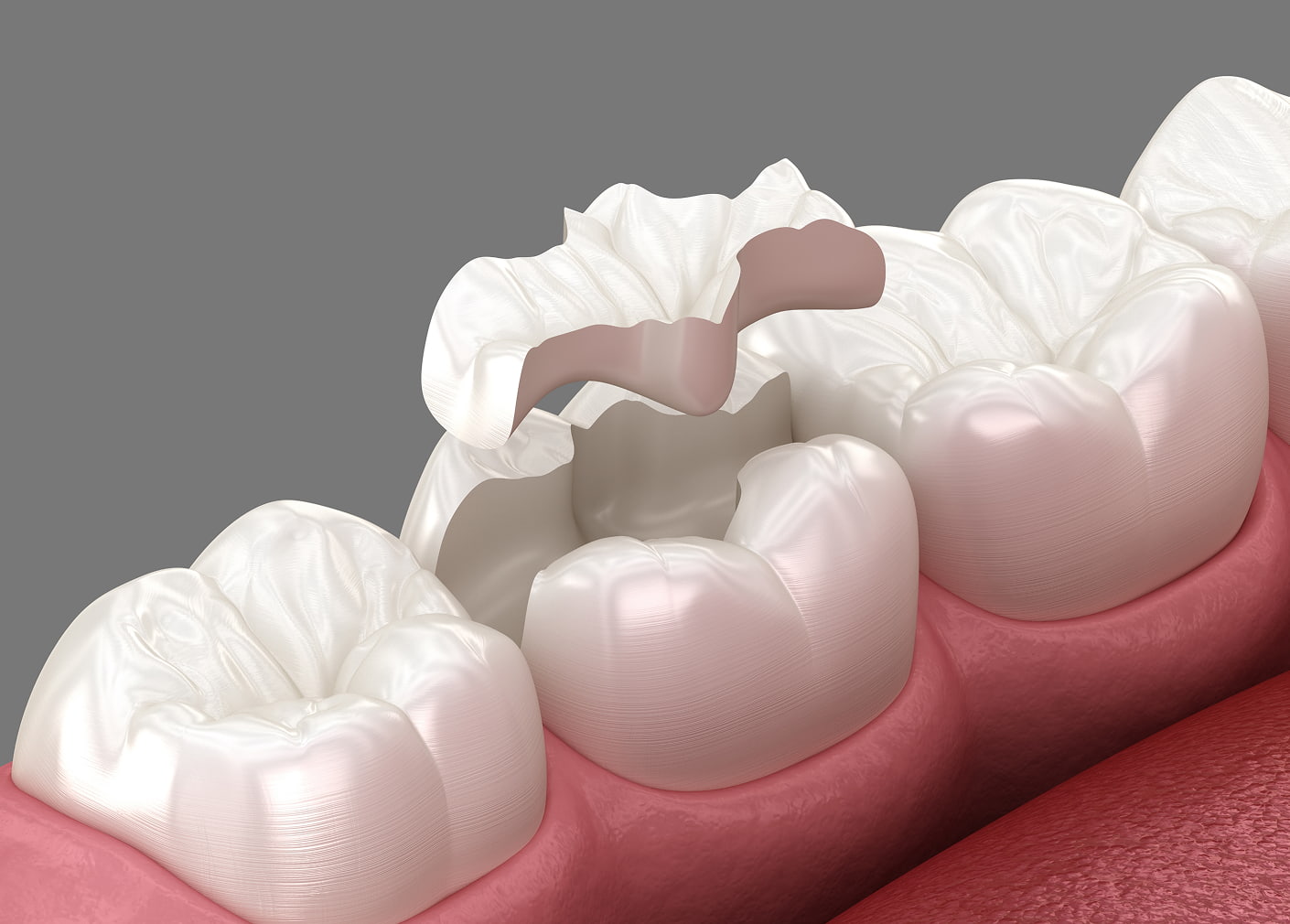 Inlays and onlays for moderate decay or damage
