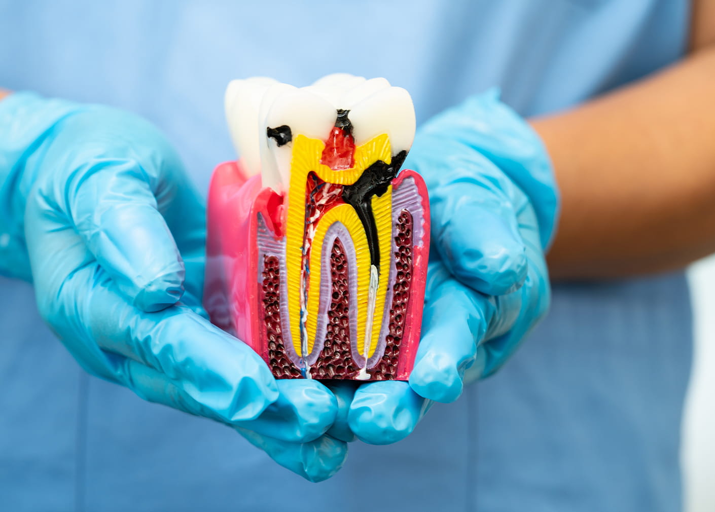 Root canals for tooth pain and decay