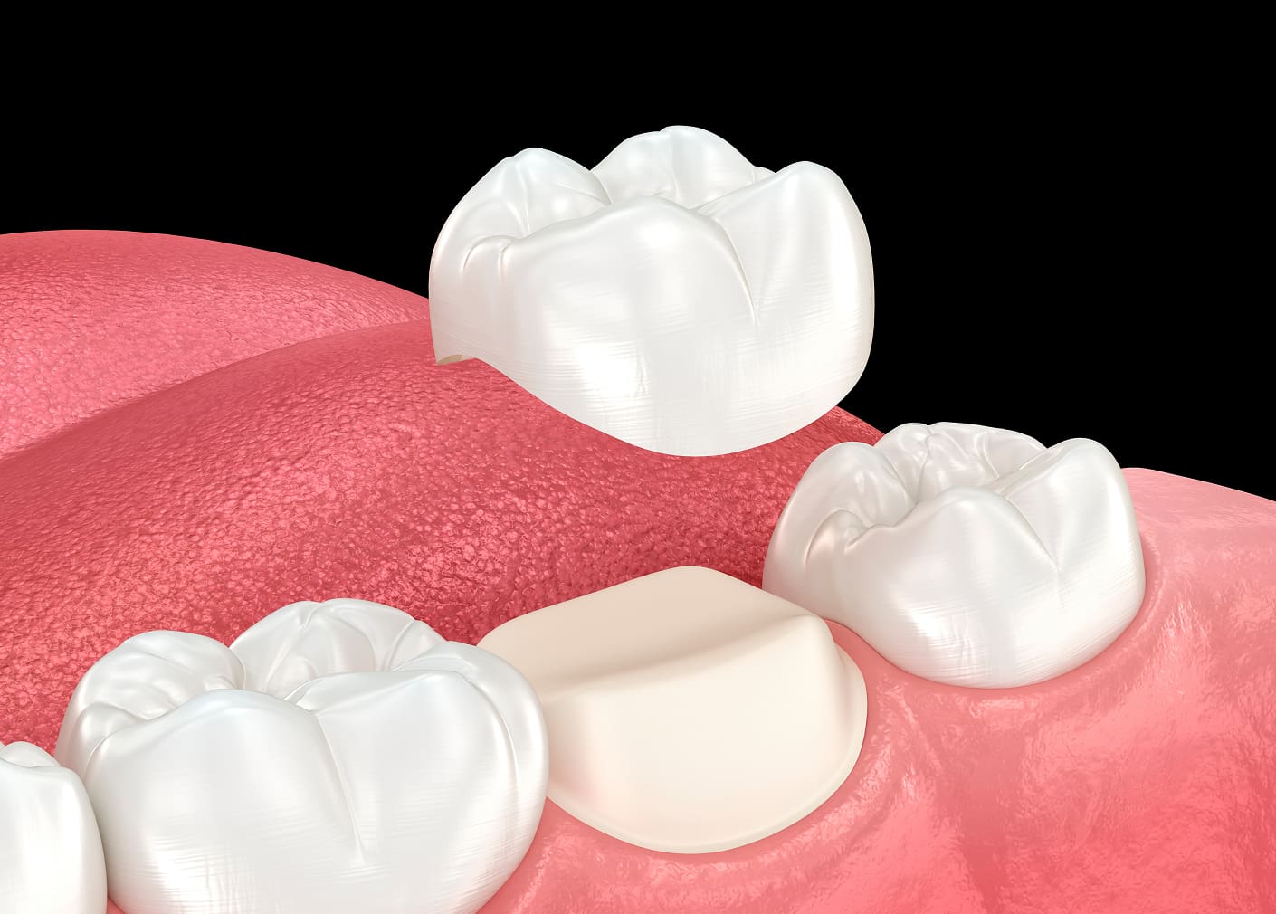 Dental Crowns