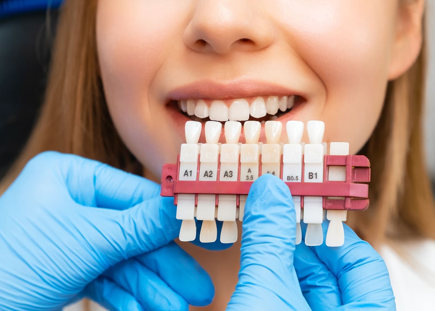 Porcelain Veneers