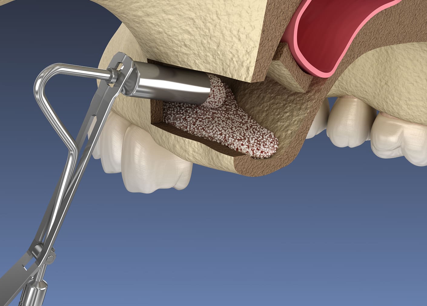 Sinus lifts for patients with bone loss