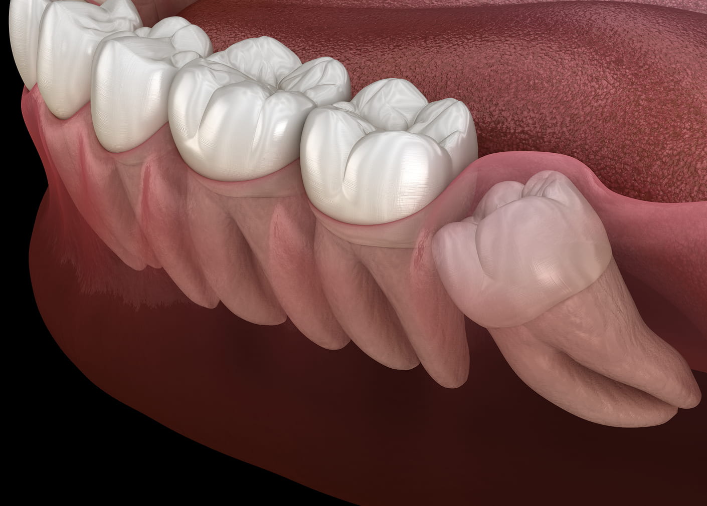 Wisdom teeth removal to prevent pain and infection