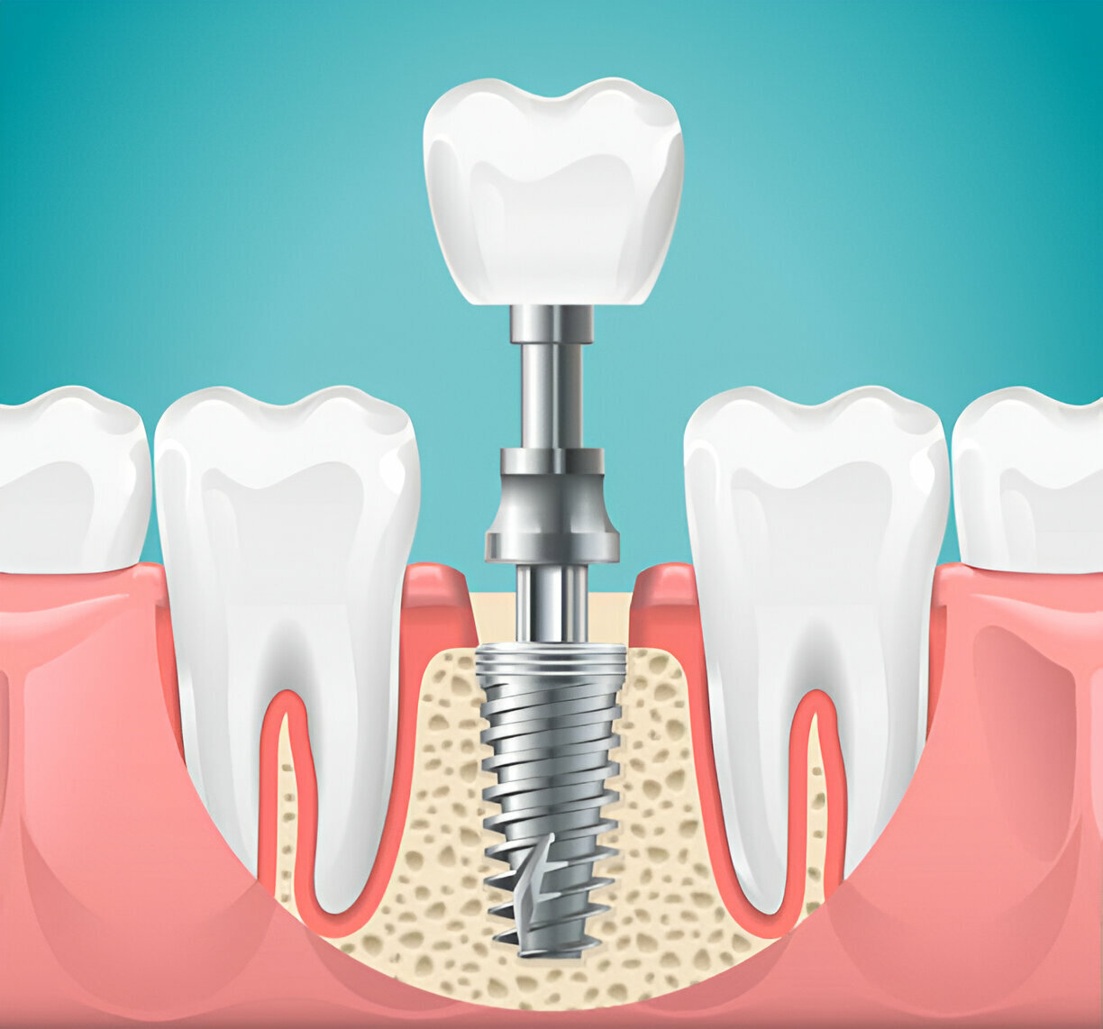 Titanium vs. Zirconia: Which Dental Implant Material is Right for You? Insights from Your Dallas, GA Dentist_FI